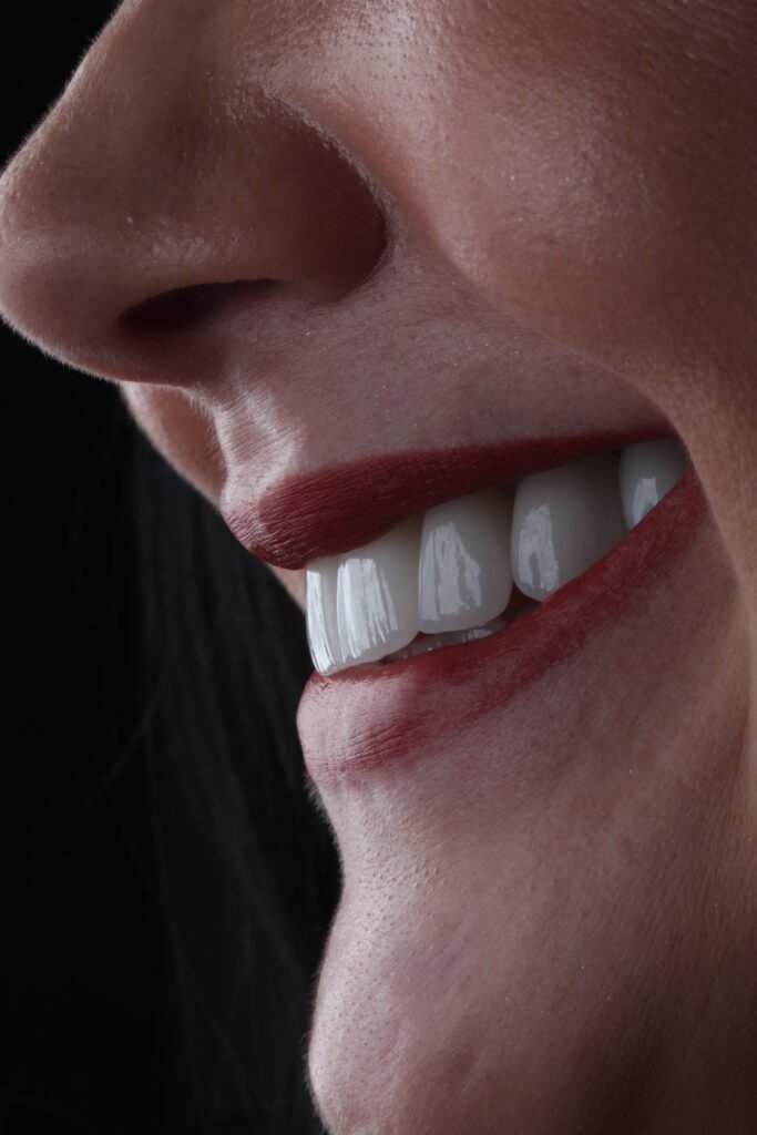 Facetas em Resina: O Sorriso dos Seus Sonhos ao Seu Alcance 1 IMG 2563.JPG