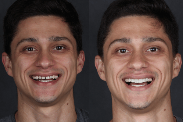 aron antesdepois