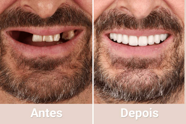 antesdepoisimplante